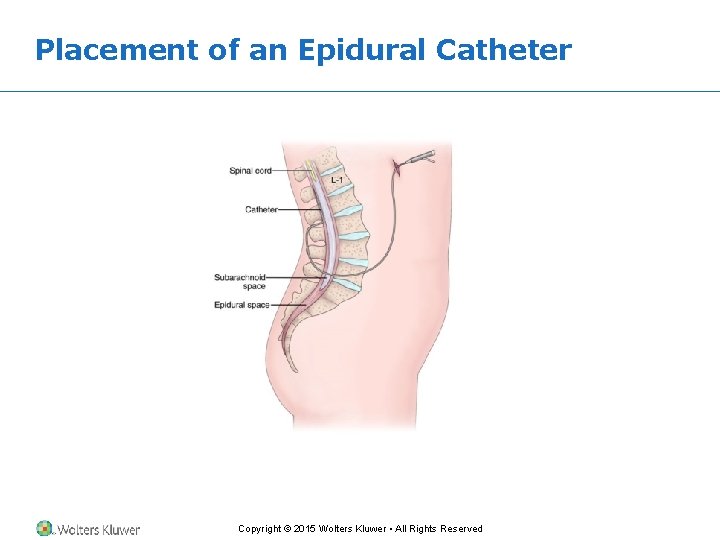 Placement of an Epidural Catheter Copyright © 2015 Wolters Kluwer • All Rights Reserved Placement of an Epidural Catheter Copyright © 2015 Wolters Kluwer • All Rights Reserved