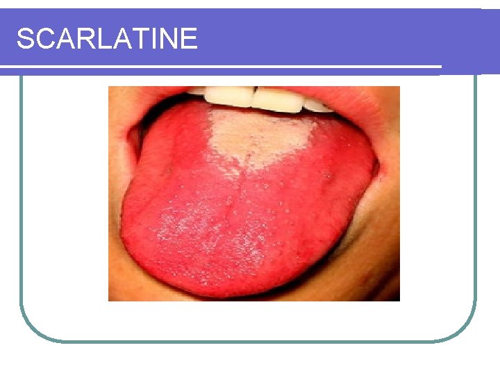 SCARLATINE 