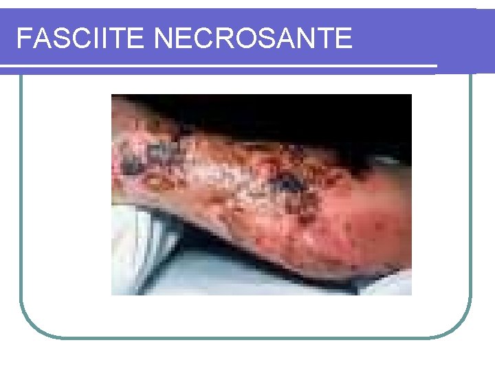 FASCIITE NECROSANTE 