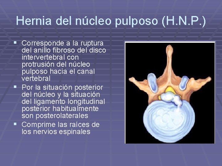 Hernia del núcleo pulposo (H. N. P. ) § Corresponde a la ruptura del Hernia del núcleo pulposo (H. N. P. ) § Corresponde a la ruptura del