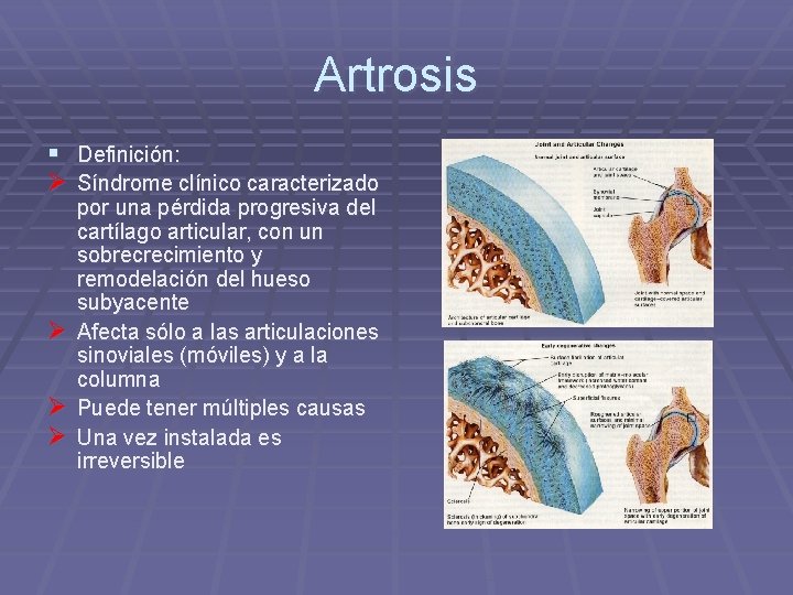 Artrosis § Definición: Ø Síndrome clínico caracterizado Ø Ø Ø por una pérdida progresiva Artrosis § Definición: Ø Síndrome clínico caracterizado Ø Ø Ø por una pérdida progresiva