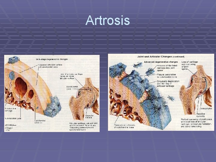 Artrosis Artrosis