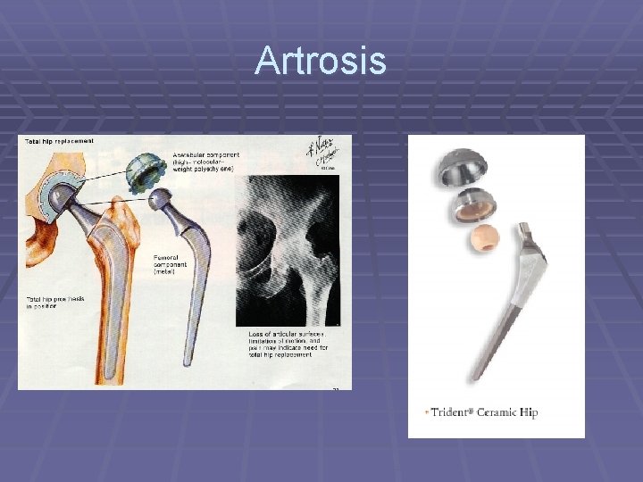 Artrosis Artrosis