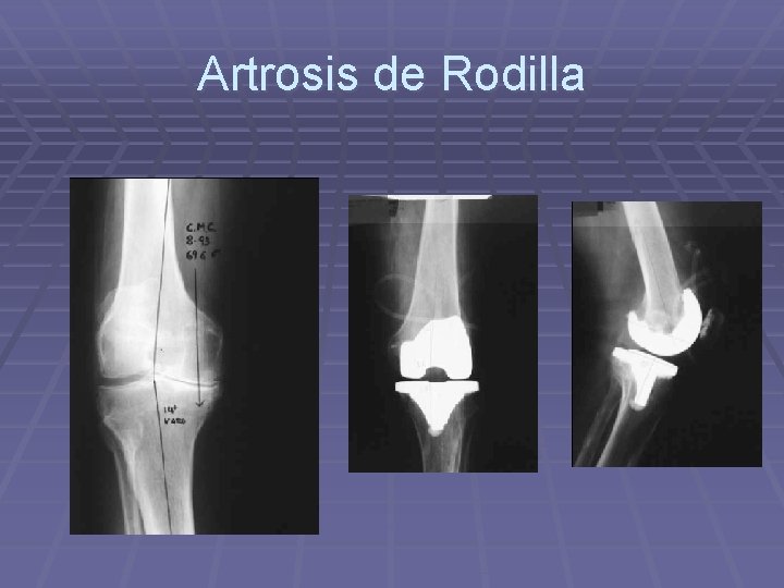 Artrosis de Rodilla Artrosis de Rodilla