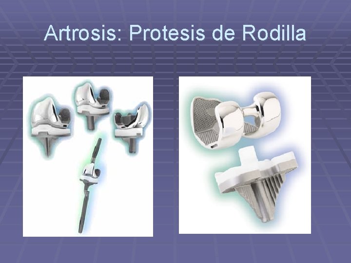 Artrosis: Protesis de Rodilla Artrosis: Protesis de Rodilla