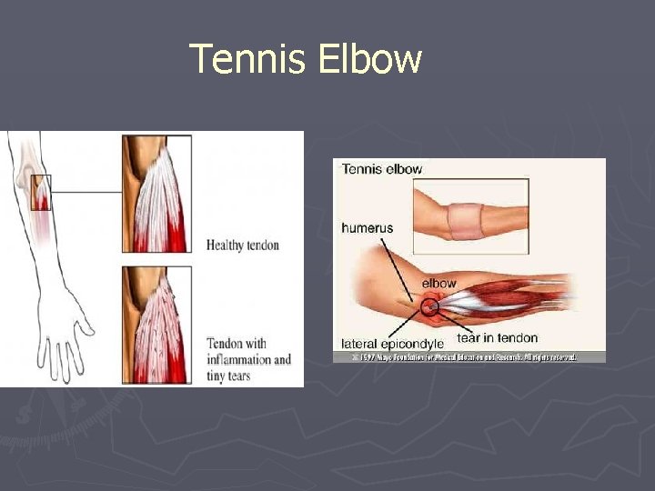 Tennis Elbow 
