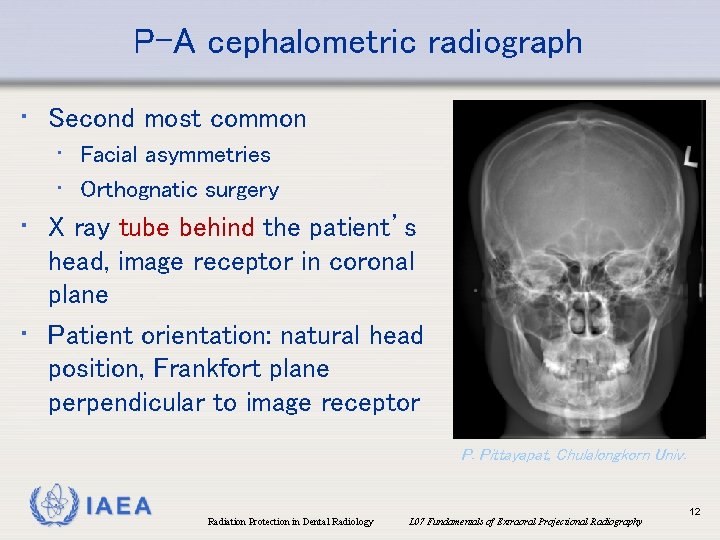 P-A cephalometric radiograph • Second most common • Facial asymmetries • Orthognatic surgery •