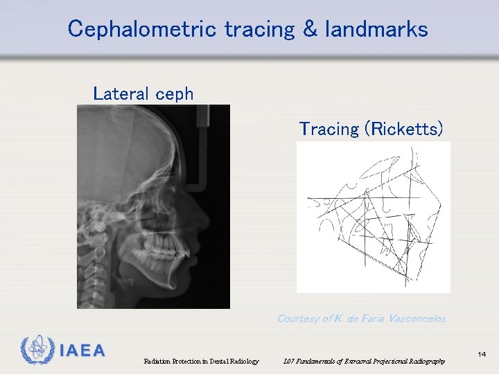 Cephalometric tracing & landmarks Lateral ceph Tracing (Ricketts) Courtesy of K. de Faria Vasconcelos