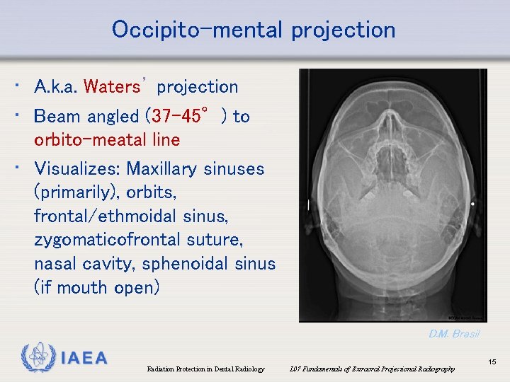 Occipito-mental projection • A. k. a. Waters’ projection • Beam angled (37 -45°) to