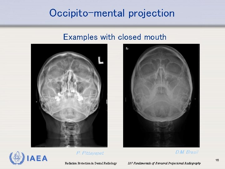 Occipito-mental projection Examples with closed mouth IAEA P. Pittayapat Radiation Protection in Dental Radiology