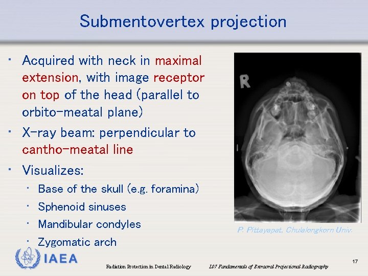 Submentovertex projection • Acquired with neck in maximal extension, with image receptor on top