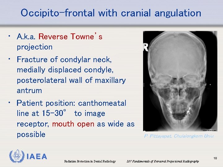 Occipito-frontal with cranial angulation • A. k. a. Reverse Towne’s projection • Fracture of