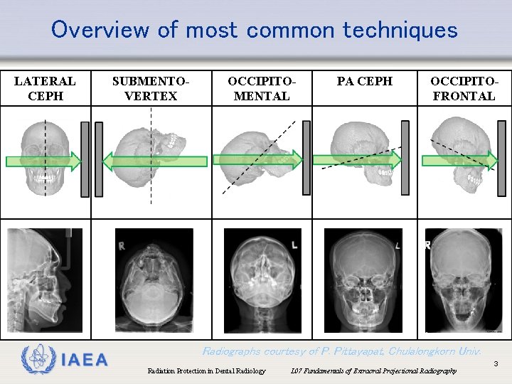 Overview of most common techniques LATERAL CEPH IAEA SUBMENTOVERTEX OCCIPITOMENTAL PA CEPH OCCIPITOFRONTAL Radiographs