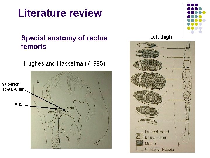 Literature review Special anatomy of rectus femoris Hughes and Hasselman (1995) Superior acetabulum AIIS