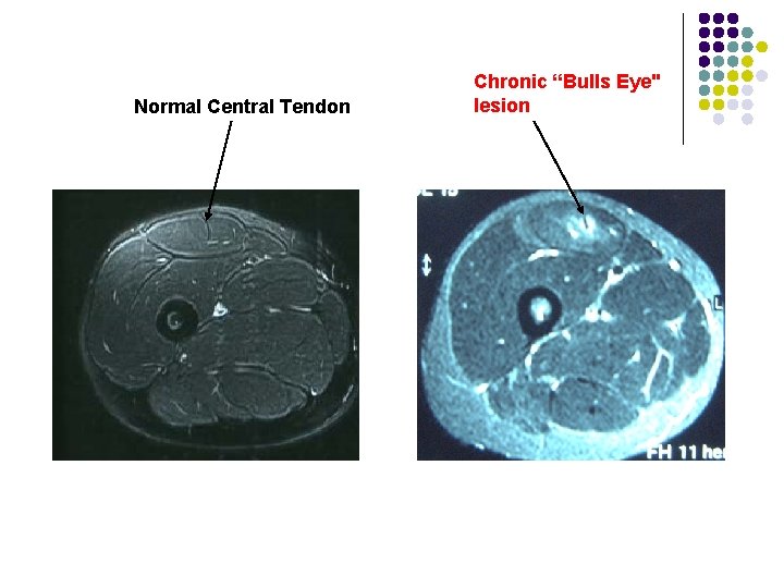 Normal Central Tendon Chronic “Bulls Eye" lesion 