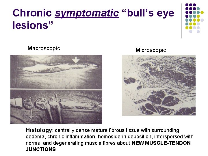 Chronic symptomatic “bull’s eye lesions” Macroscopic Microscopic Histology: centrally dense mature fibrous tissue with