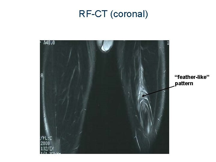 RF-CT (coronal) “feather-like” pattern 
