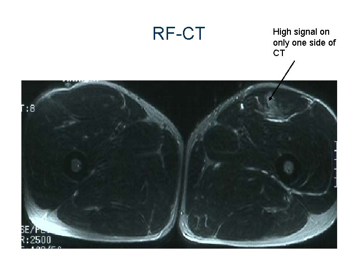 RF-CT High signal on only one side of CT 