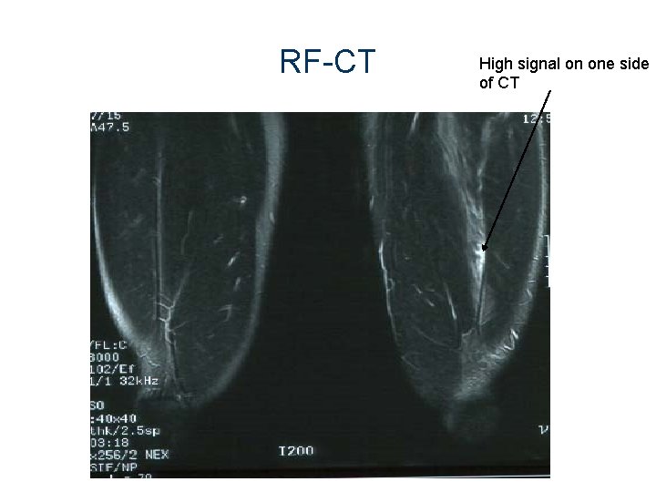 RF-CT High signal on one side of CT 