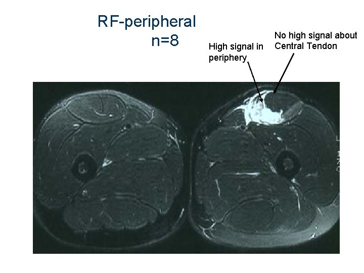 RF-peripheral n=8 High signal in periphery No high signal about Central Tendon 