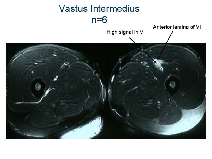 Vastus Intermedius n=6 High signal in VI Anterior lamina of VI 