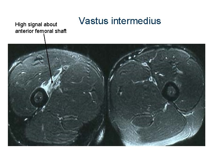 High signal about anterior femoral shaft Vastus intermedius 