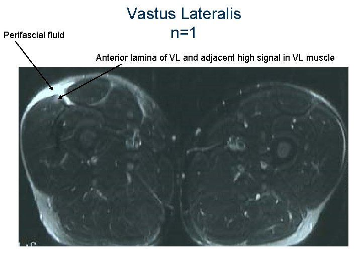Perifascial fluid Vastus Lateralis n=1 Anterior lamina of VL and adjacent high signal in