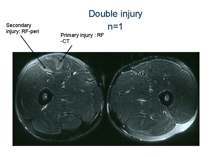 Secondary injury: RF-peri Double injury n=1 Primary injury : RF -CT 