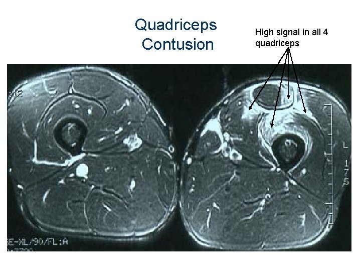 Quadriceps Contusion High signal in all 4 quadriceps 