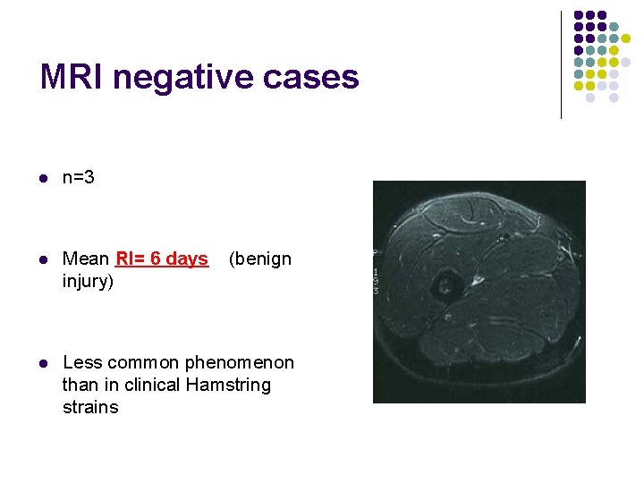 MRI negative cases l n=3 l Mean RI= 6 days injury) l Less common