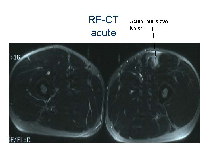 RF-CT acute Acute “bull’s eye” lesion 