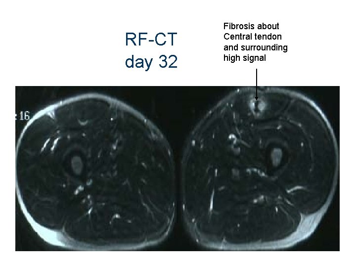RF-CT day 32 Fibrosis about Central tendon and surrounding high signal 