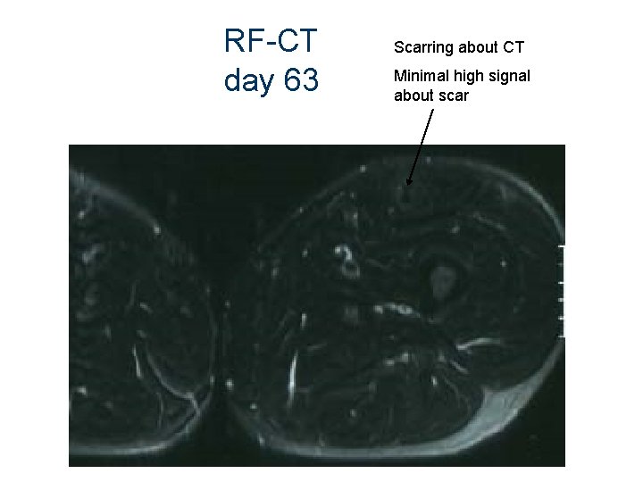 RF-CT day 63 Scarring about CT Minimal high signal about scar 