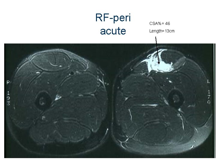 RF-peri acute CSA%= 46 Length=13 cm 