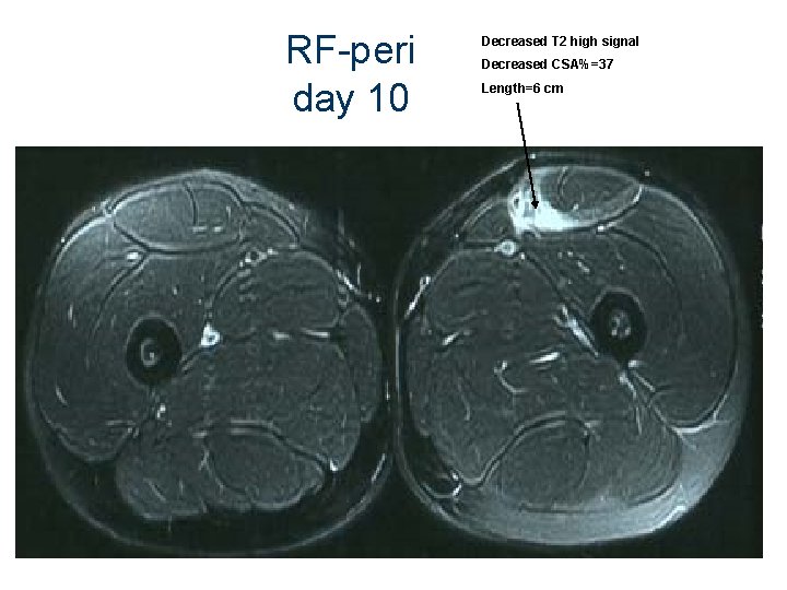 RF-peri day 10 Decreased T 2 high signal Decreased CSA%=37 Length=6 cm 