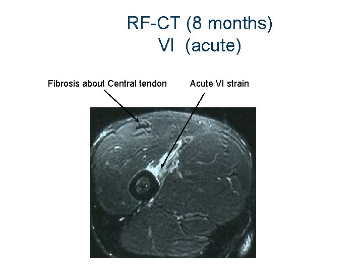 RF-CT (8 months) VI (acute) Fibrosis about Central tendon Acute VI strain 