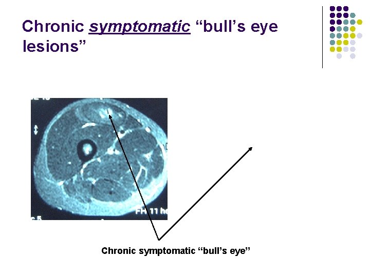 Chronic symptomatic “bull’s eye lesions” Chronic symptomatic “bull’s eye” 