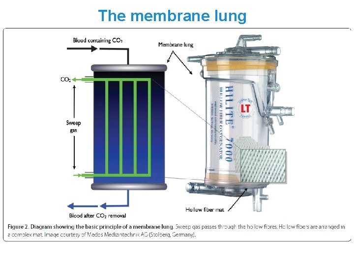 The membrane lung The membrane lung