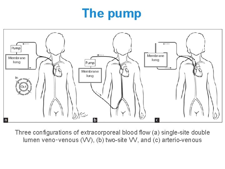 The pump Membrane lung Three configurations of extracorporeal blood flow (a) single-site double lumen The pump Membrane lung Three configurations of extracorporeal blood flow (a) single-site double lumen