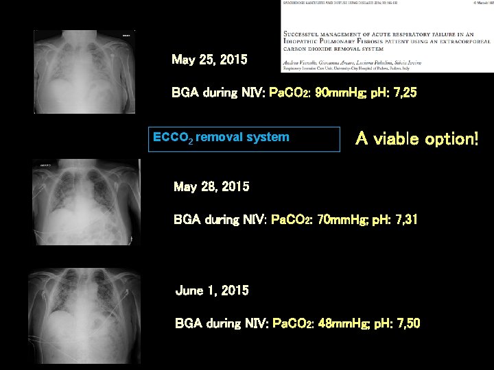 May 25, 2015 BGA during NIV: Pa. CO 2: 90 mm. Hg; p. H: May 25, 2015 BGA during NIV: Pa. CO 2: 90 mm. Hg; p. H: