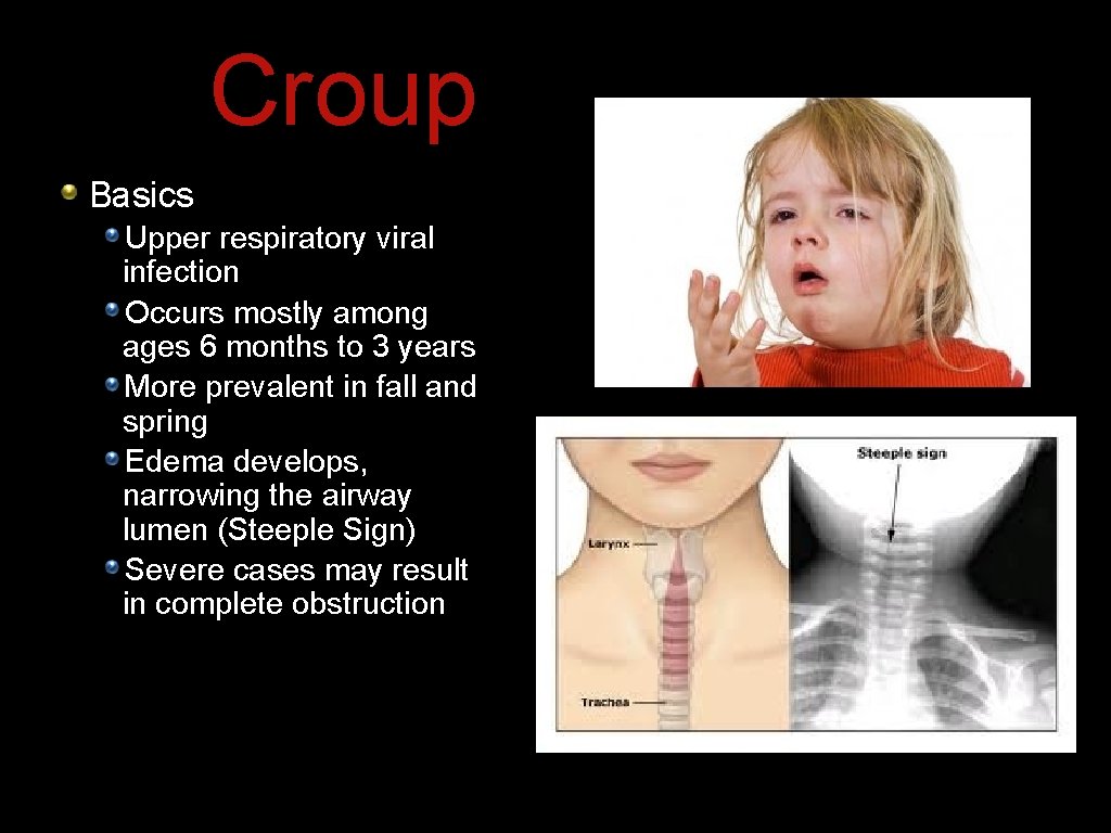 Croup Basics Upper respiratory viral infection Occurs mostly among ages 6 months to 3 Croup Basics Upper respiratory viral infection Occurs mostly among ages 6 months to 3