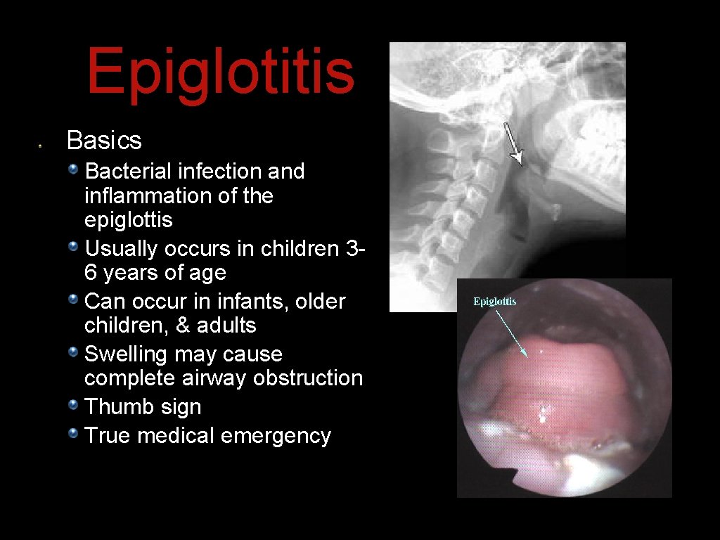 Epiglotitis Basics Bacterial infection and inflammation of the epiglottis Usually occurs in children 36 Epiglotitis Basics Bacterial infection and inflammation of the epiglottis Usually occurs in children 36