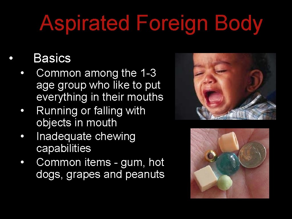 Aspirated Foreign Body • Basics • • Common among the 1 -3 age group Aspirated Foreign Body • Basics • • Common among the 1 -3 age group