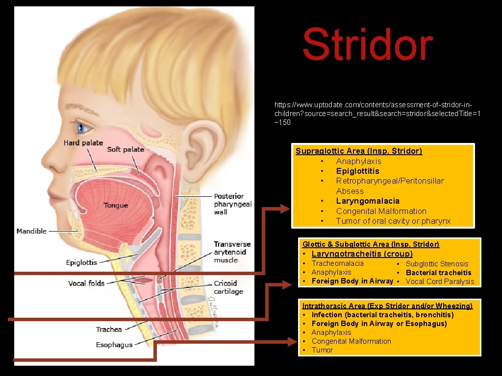 Stridor https: //www. uptodate. com/contents/assessment-of-stridor-inchildren? source=search_result&search=stridor&selected. Title=1 ~150 Supraglottic Area (Insp. Stridor) • Anaphylaxis Stridor https: //www. uptodate. com/contents/assessment-of-stridor-inchildren? source=search_result&search=stridor&selected. Title=1 ~150 Supraglottic Area (Insp. Stridor) • Anaphylaxis