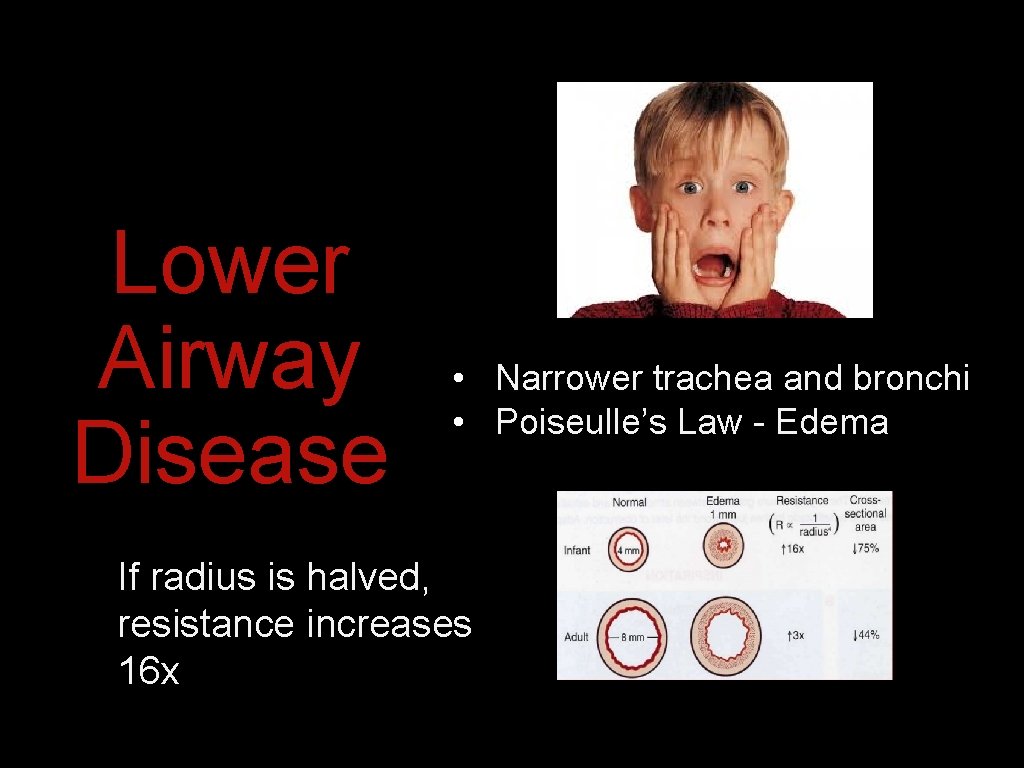 Lower Airway Disease • Narrower trachea and bronchi • Poiseulle’s Law - Edema If Lower Airway Disease • Narrower trachea and bronchi • Poiseulle’s Law - Edema If