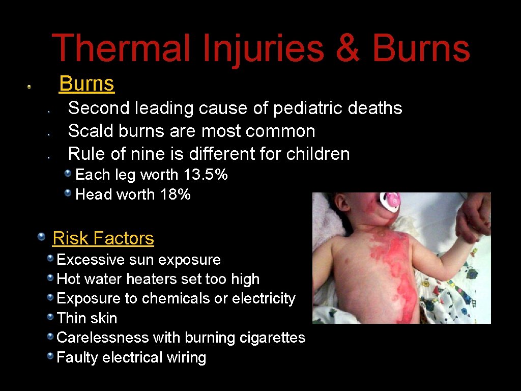 Thermal Injuries & Burns Second leading cause of pediatric deaths Scald burns are most Thermal Injuries & Burns Second leading cause of pediatric deaths Scald burns are most
