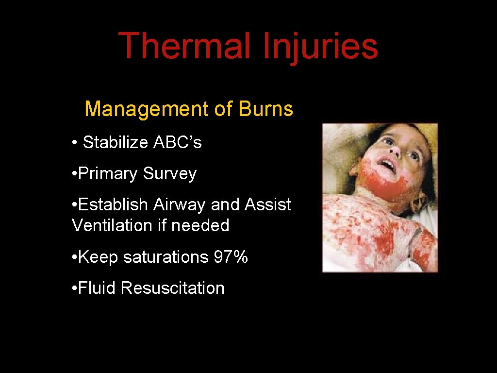Thermal Injuries Management of Burns • Stabilize ABC’s • Primary Survey • Establish Airway Thermal Injuries Management of Burns • Stabilize ABC’s • Primary Survey • Establish Airway