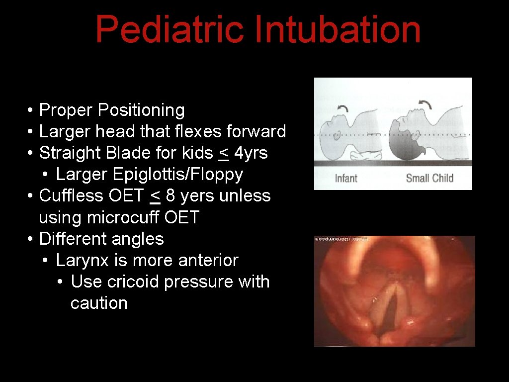 Pediatric Intubation • Proper Positioning • Larger head that flexes forward • Straight Blade Pediatric Intubation • Proper Positioning • Larger head that flexes forward • Straight Blade