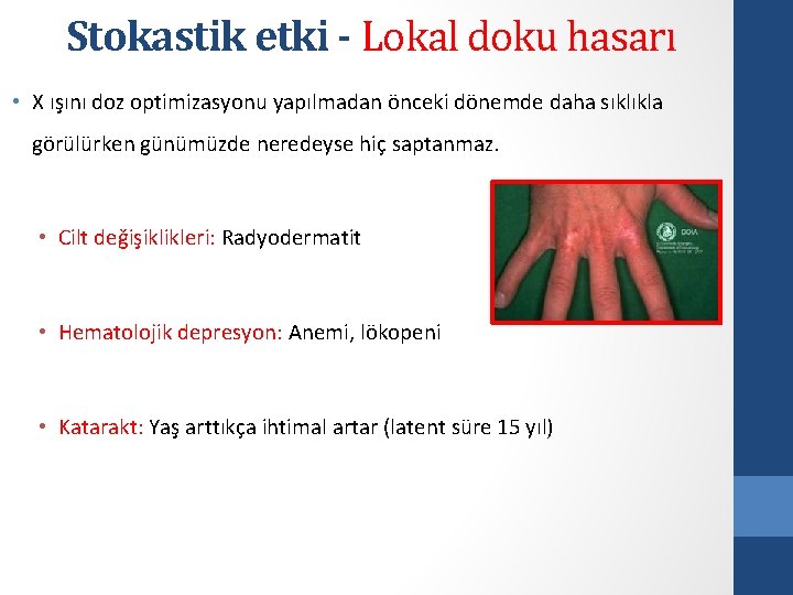 Stokastik etki - Lokal doku hasarı • X ışını doz optimizasyonu yapılmadan önceki dönemde