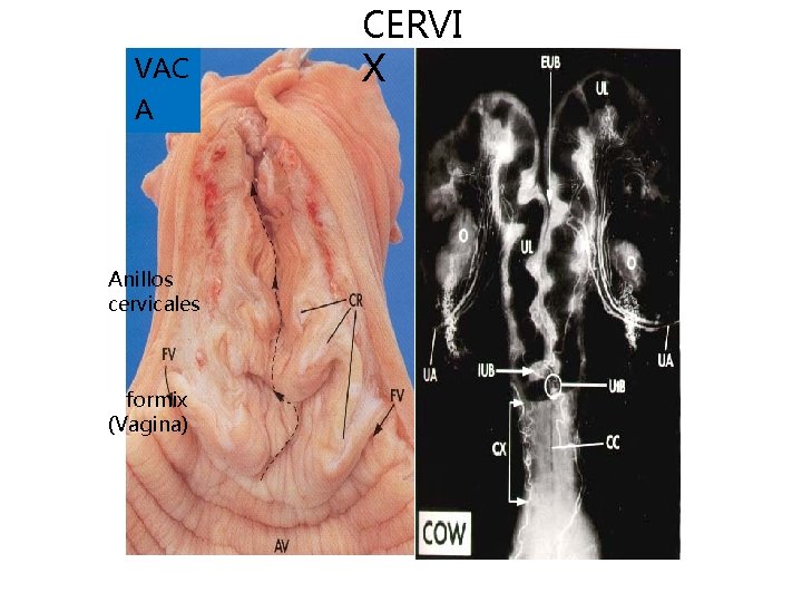 VAC A Anillos cervicales formix (Vagina) CERVI X 